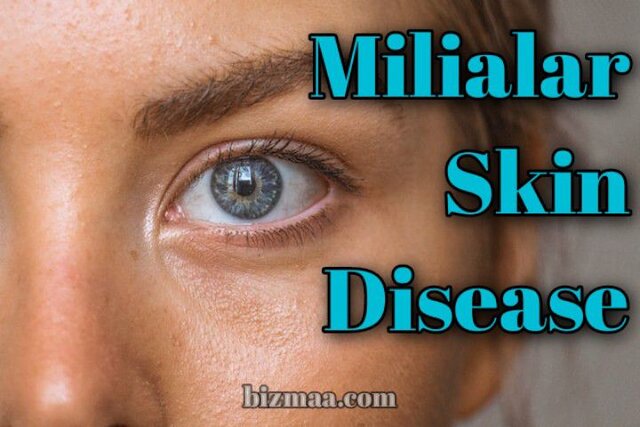 Milialar Skin Disease Understanding The Causes & Treatment